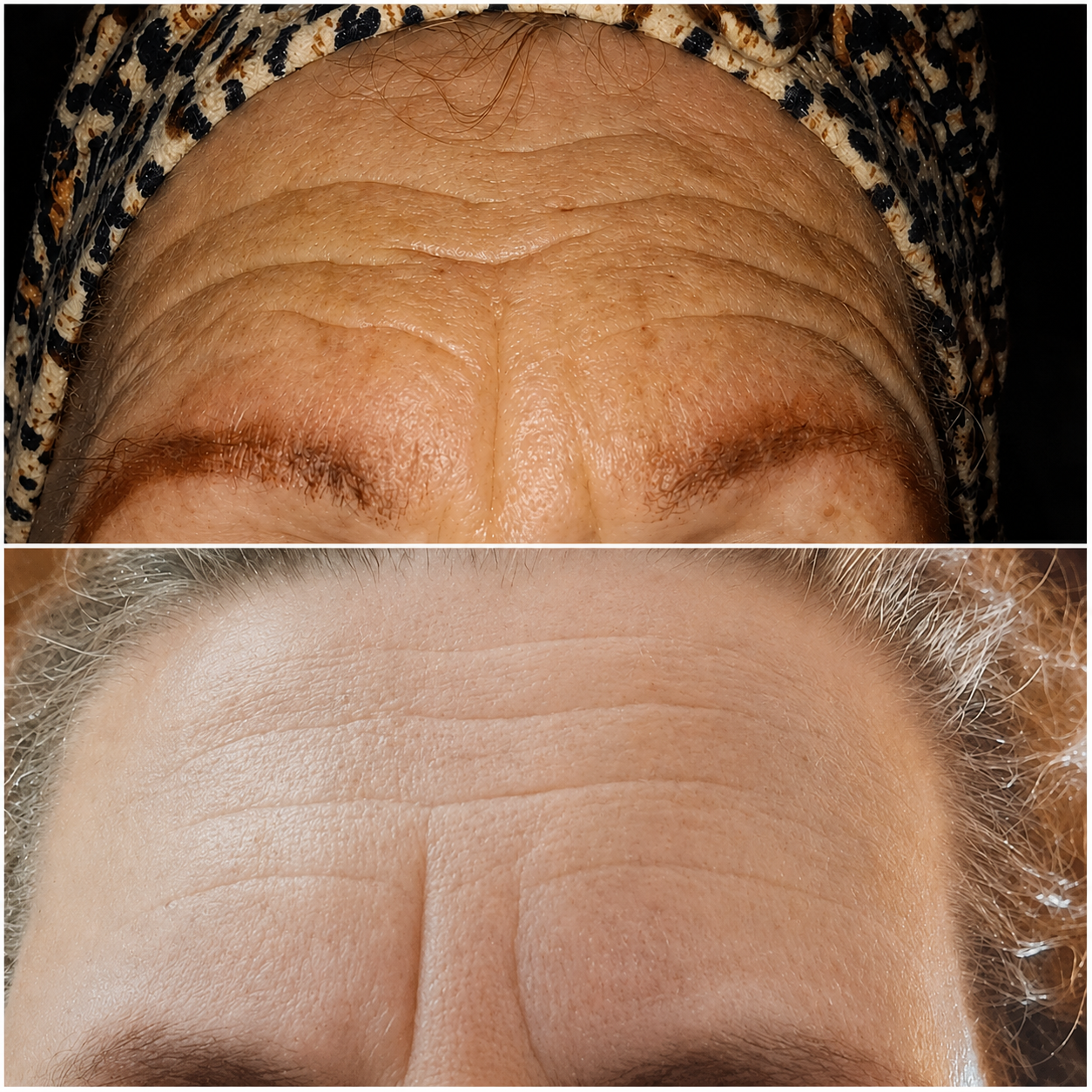 Paciente recibiendo lifting facial con acupuntura